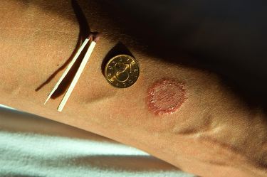 ringworm